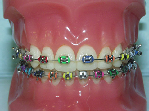 metal-braces.jpg