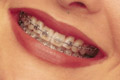 Metal braces