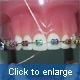 Clean the sides of the teeth