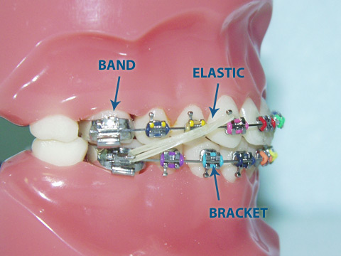  Bands: Small and thin metal rings placed around the back teeth (i.e. 