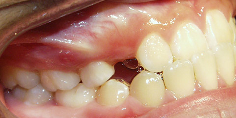 Class Iii Malocclusion