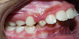 Class II malocclusion