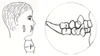 Class I malocclusion