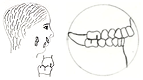 Class II malocclusion