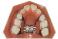 Palatal expander